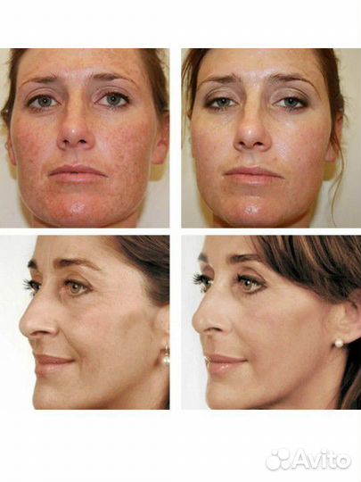 Биоревитализация