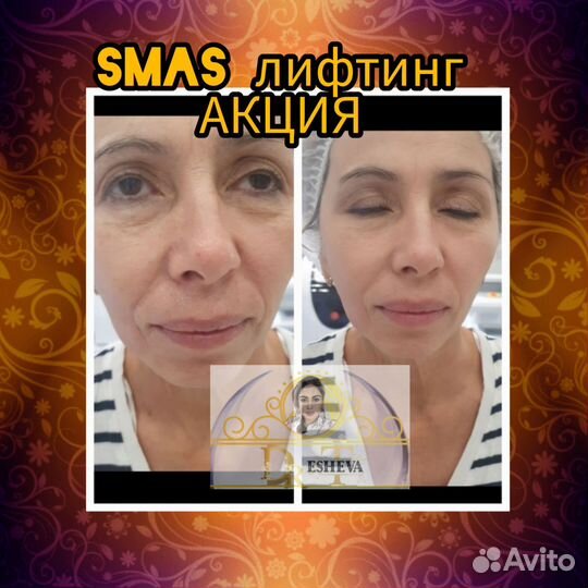 RF лифтинг, Smas лифтинг, микроигольчатый RF
