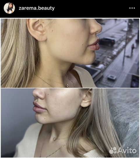 Нужны модели на ботокс лица)