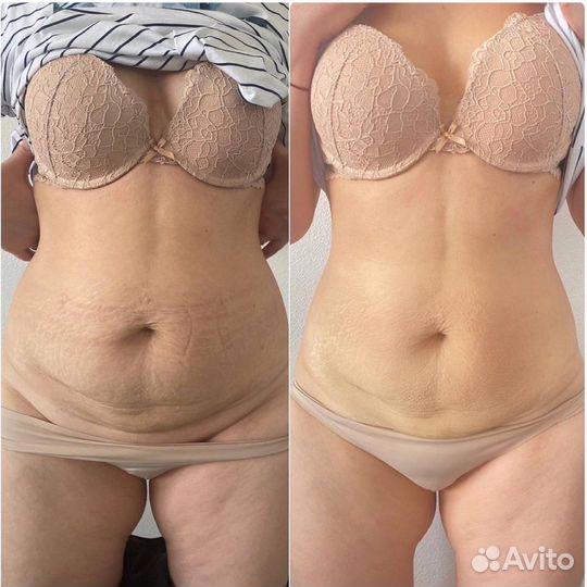 Стройная фигура - Аппаратная коррекция фигуры