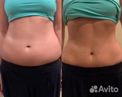 EMS стимуляция в Славянке