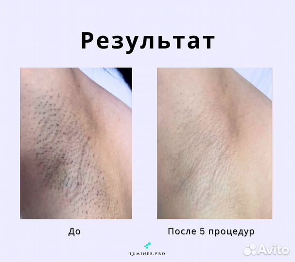 Диодный лазер для эпиляции Lumines’ Max’One 1200 Вт