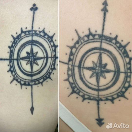 Лазерное удаление тату и татуажа