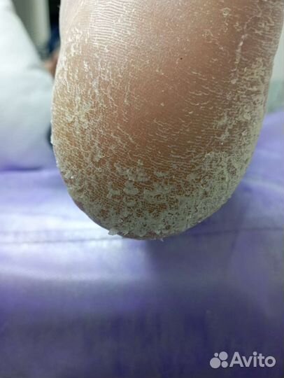 Коррекция вросшего ногтя