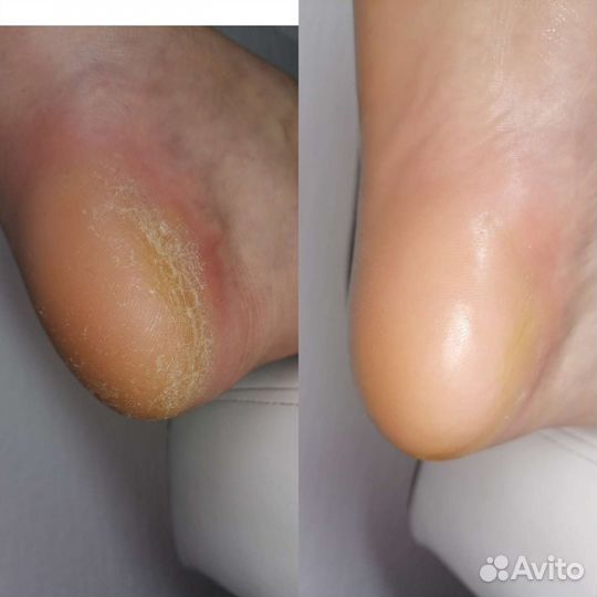 Смарт педикюр