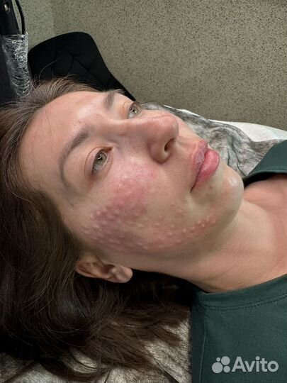 Ботокс лица, биоревитализвция, мезотерапия