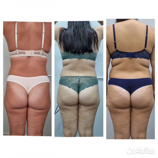 Аппаратный массаж LPG