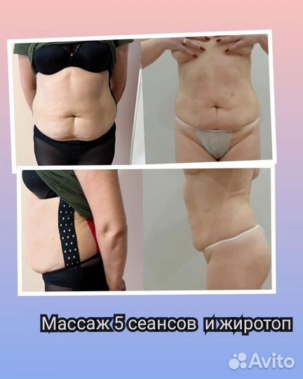 Липолитики мезотерапия