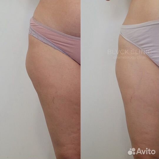 Криолиполиз на оригинальном аппарате Coccon