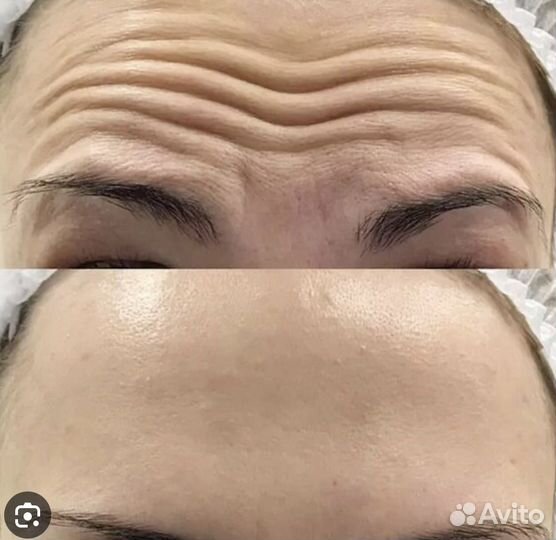 Чистки лица