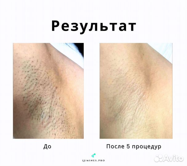 Диодный лазер Люминес’ Макс Ван 1200W