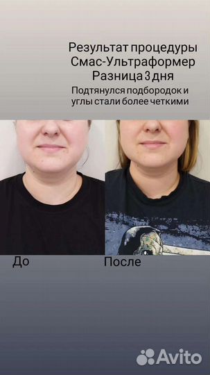 Смас-лифтинг Ультраформер