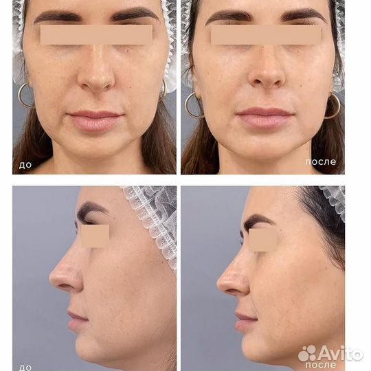 СМАС лифтинг, тотальное омоложение лица