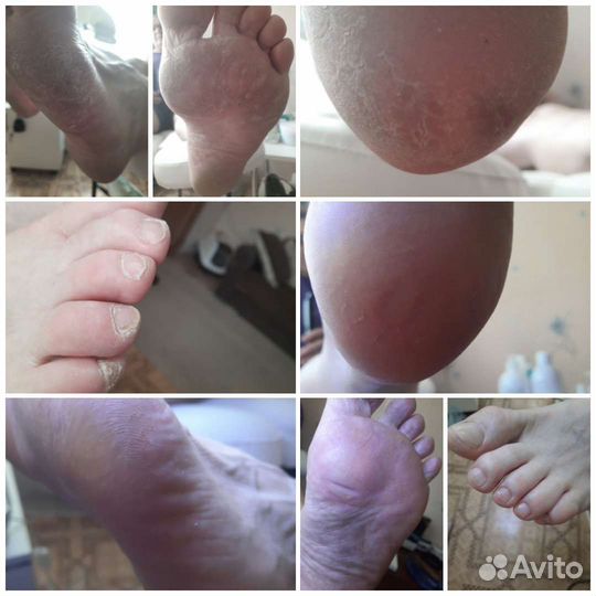 Педикюр медицинский (подолог)с выездом на дом