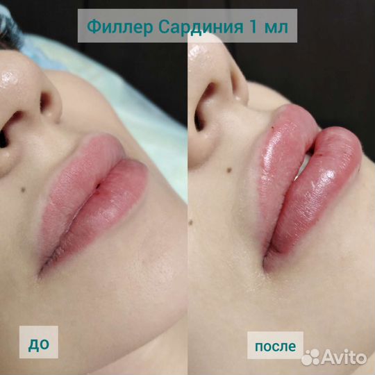 Красивые губы, увлажнение губ, Биоревитализация