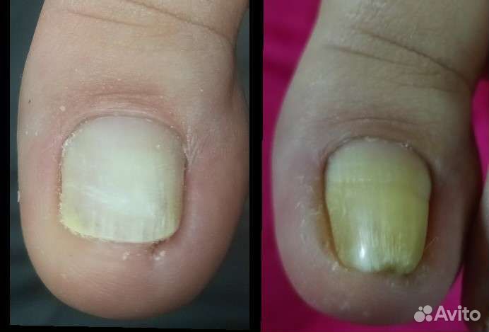 Медицинский педикюр подолог