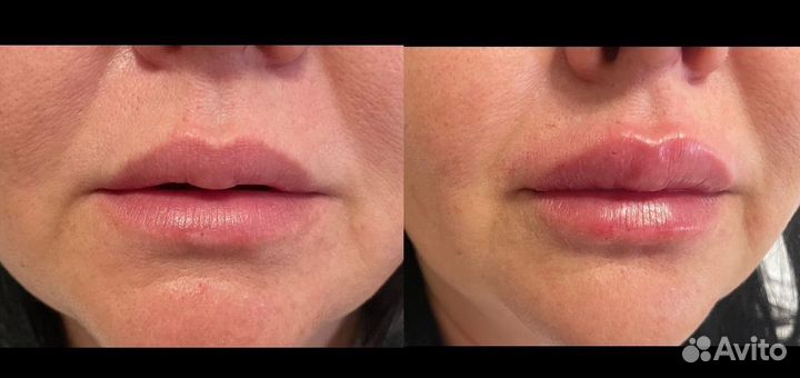 Увеличение губ