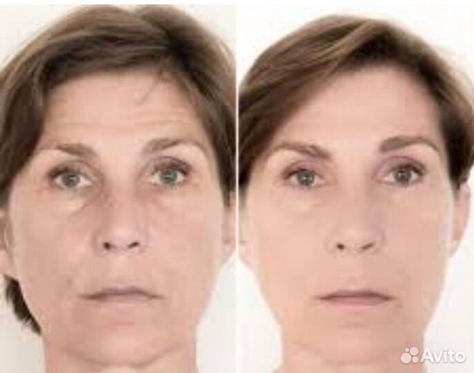 Тренажер для мышц лица и шеи