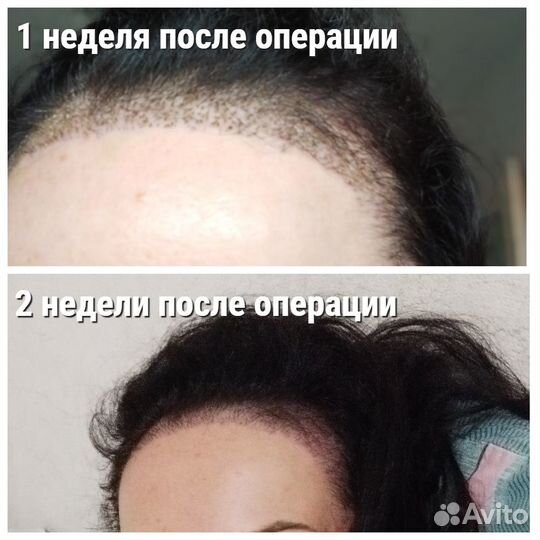 Пересадка волос в Турции