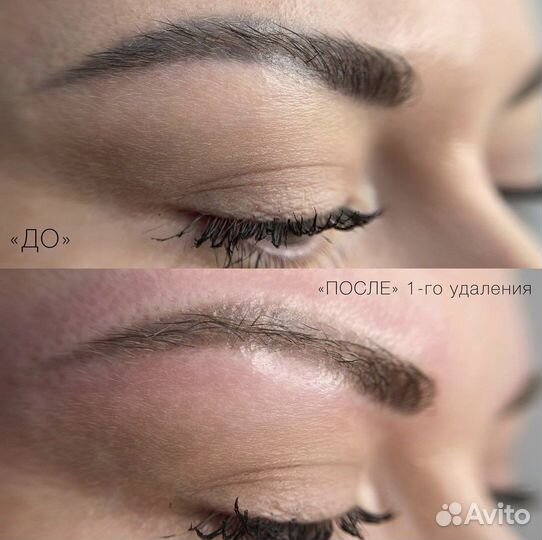 Лазерное удаление тату и татуажа