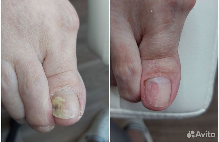 Подолог, педикюр