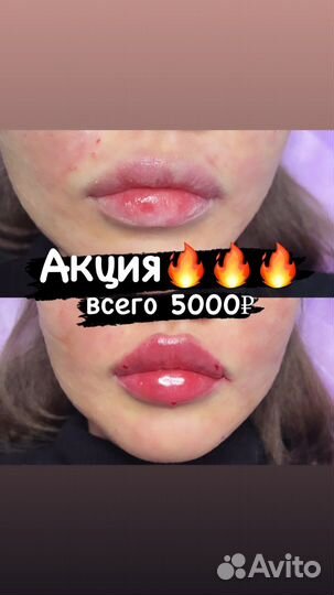Увеличение губ