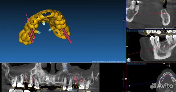 Хирургический шаблон RealGuide,BlueSkyPlan,ExoCad