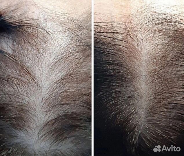 Холодная плазма омоложение лица и тела