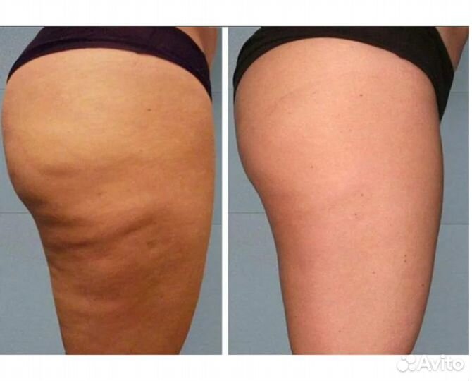 Коррекция целлюлита и жира, лифтинг кожи. акция