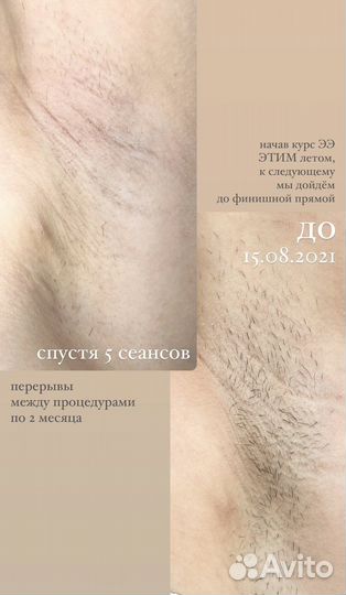Модели на электроэпиляцию Apilus, Evolution 7HD