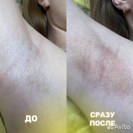 Электроэпиляция