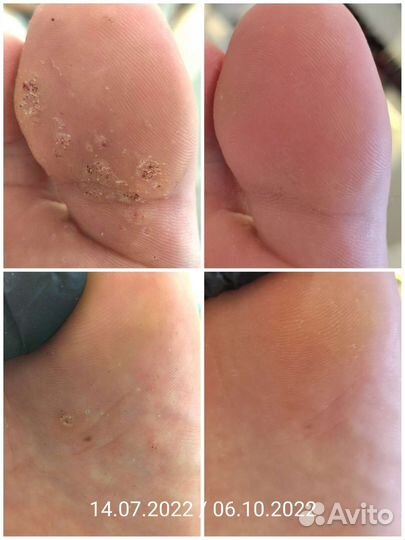 Педикюр/Подология/Работа со сложной стопой