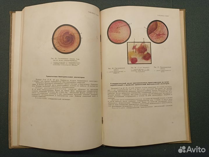 Ректороманоскопия. Чулков. 1952