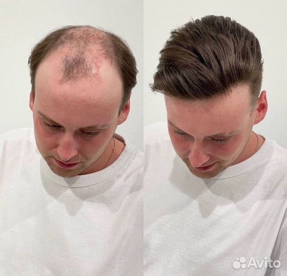 Установка систем замещения волос