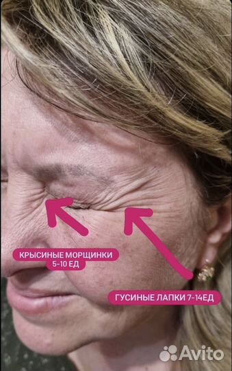 Модель на ботокс