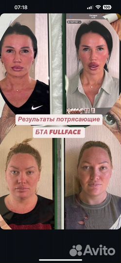 Нитивой лифтинг