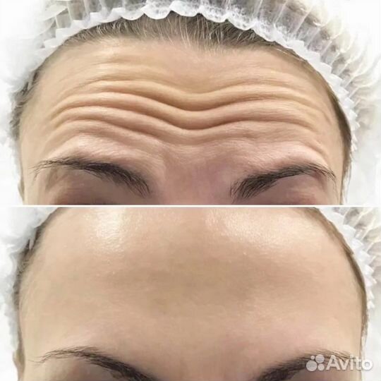 Ботокс лица
