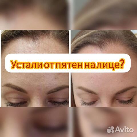 Убрать пигментные пятна, отбелить лицо даже летом