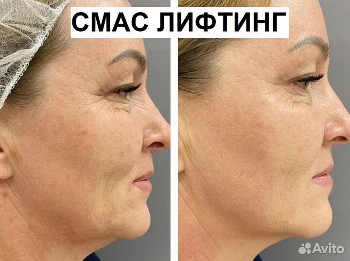 Омоложение лица. Смас лифтинг