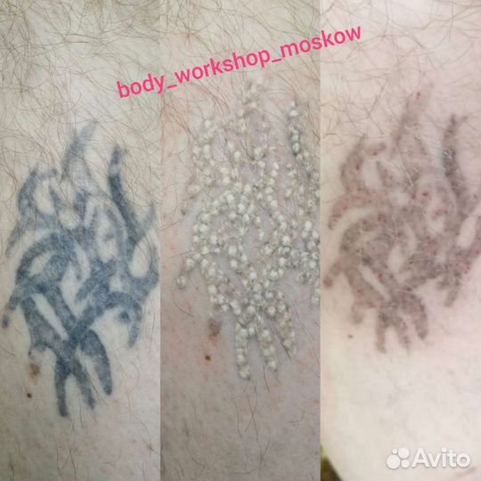Удаление татуировок и татуажа
