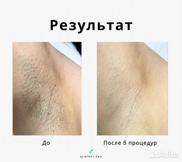 Диодный лазер для эпиляции Lumines’ Макс-Ван 1200в