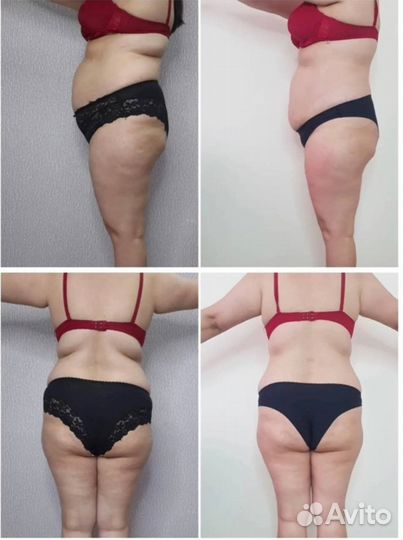 Криолиполиз,lpg массаж, кавитация,RF лифтинг