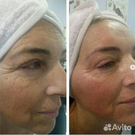 Аппаратная косметология