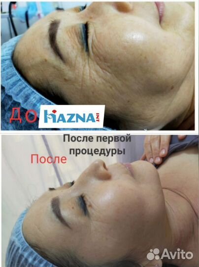 Нужны модели для лифтинг системы шарм. бесплатно