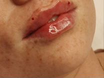 Контурная пластика губ, ботулинотерапия