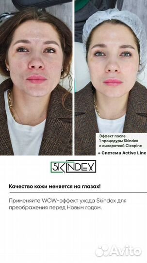 Омоложение лица