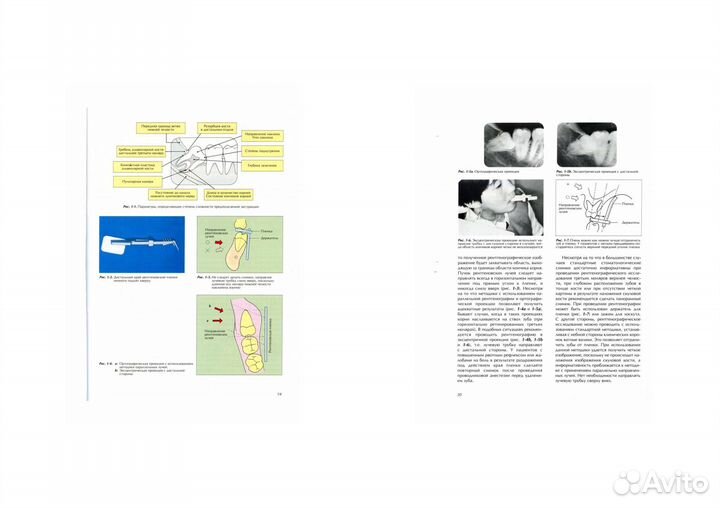 Квалифицированное удаление третьих моляров
