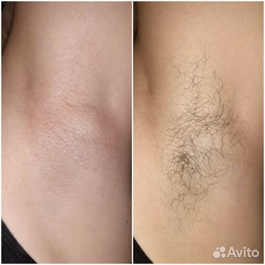 Шугаринг, эпиляция