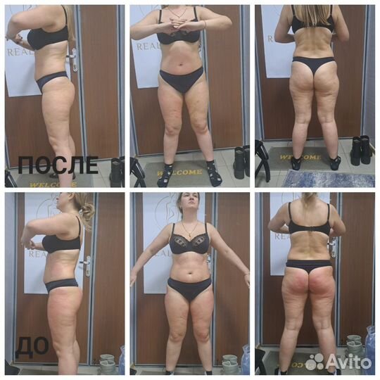 Коррекция фигуры Волгоград