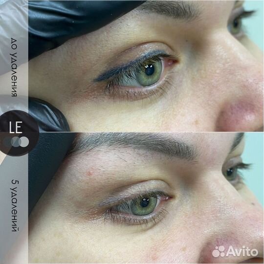 Удаление татуажа/тату на пикосекундном лазере